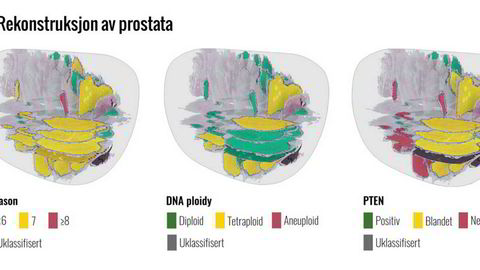 De tre vanligste metodene for å analysere kreftsvulster i prostata. De de fargede feltene viser endringer i pasientens i celler og vev. Rødt viser de alvorligste endringene, deretter gult og grønt. Nye forskningsresultater viser at variasjonene mellom hva de ulike testene finner er så store at det trengs utvikling av nye verktøy